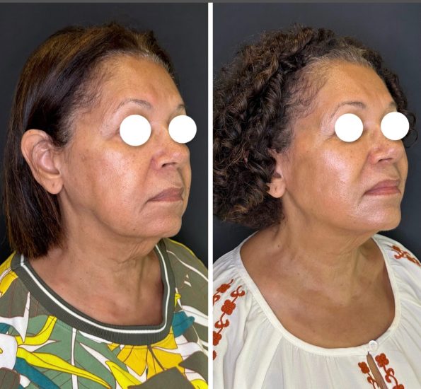 Antes e depois pra acrescentar_