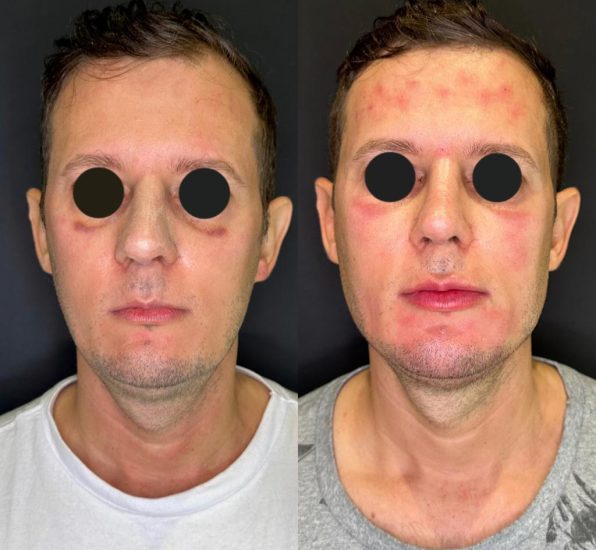Harmonização facial antes e depois masculino